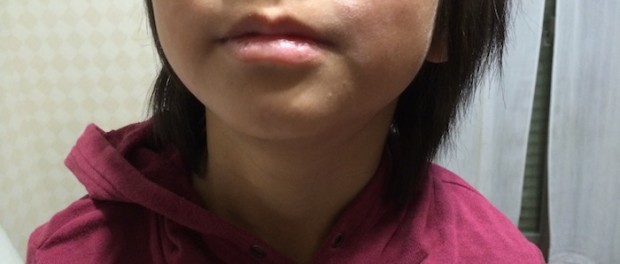 小児顔面粃糠疹(しょうにがんめんひこうしん)